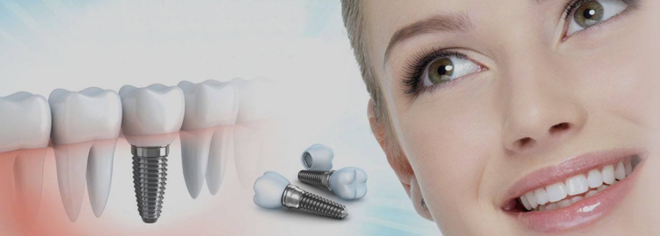 Dental implants in Bangalore